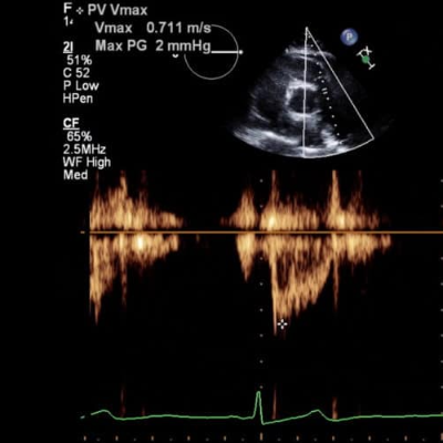 2D Echo Ultrasound