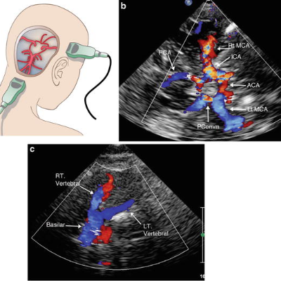 Transcranial Doppler Ultrasound